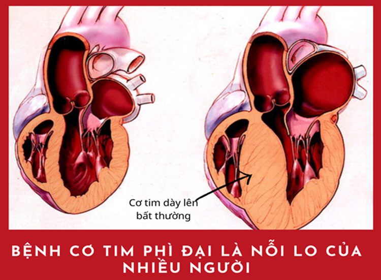 Bệnh cơ tim phì đại có thể được kiểm soát tốt nếu bạn hiểu rõ về bệnh
